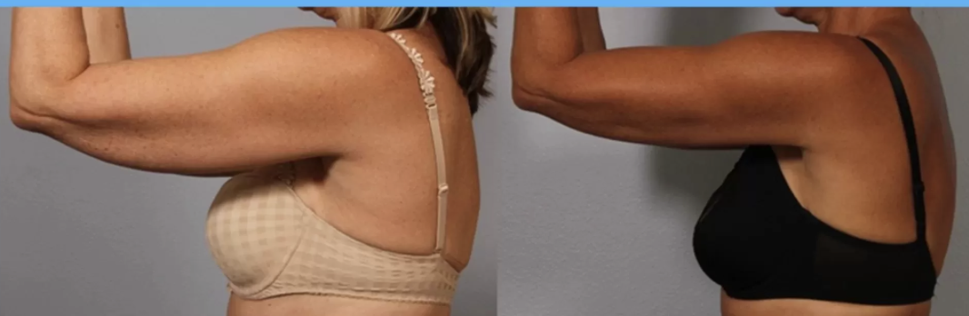 Comparação de antes e depois de um caso de lifting de braços